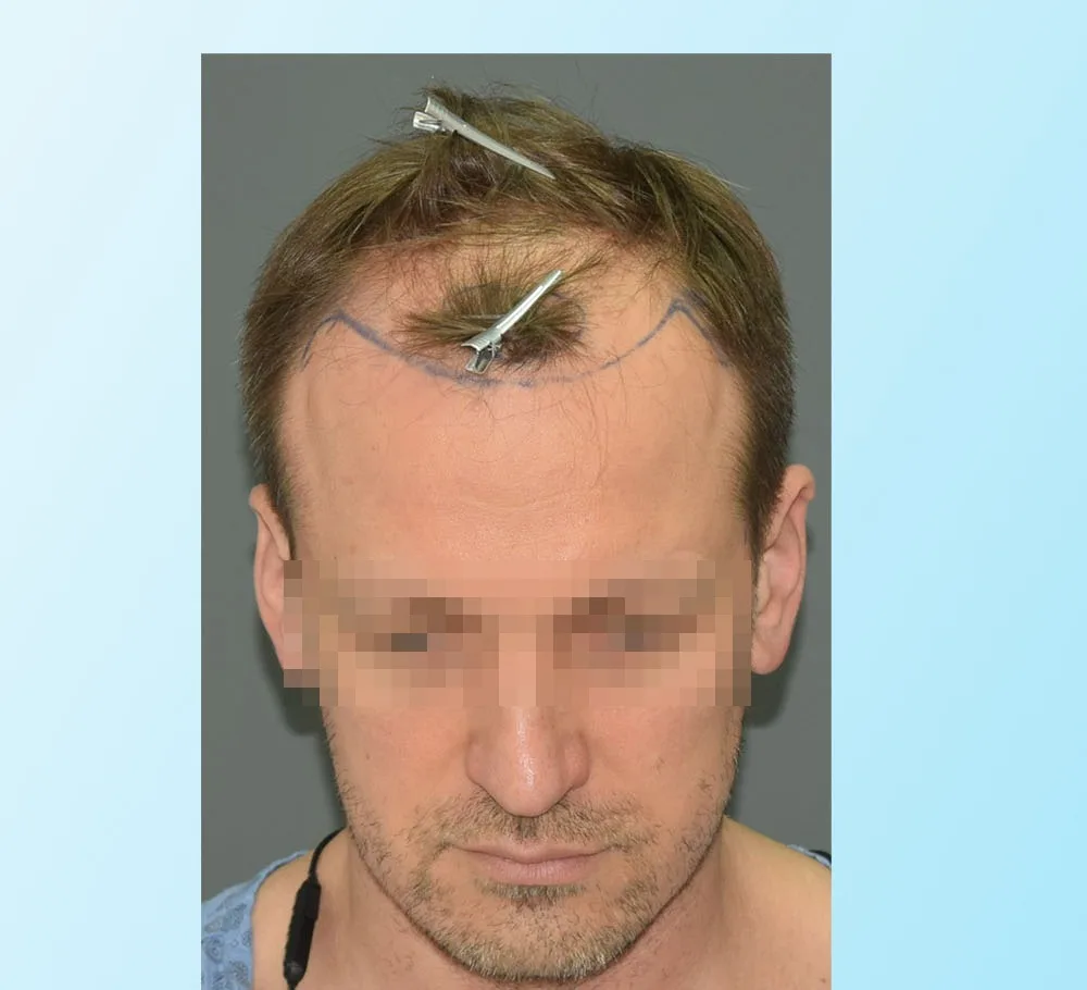Male patient before a hair transplant, thinning front and crown