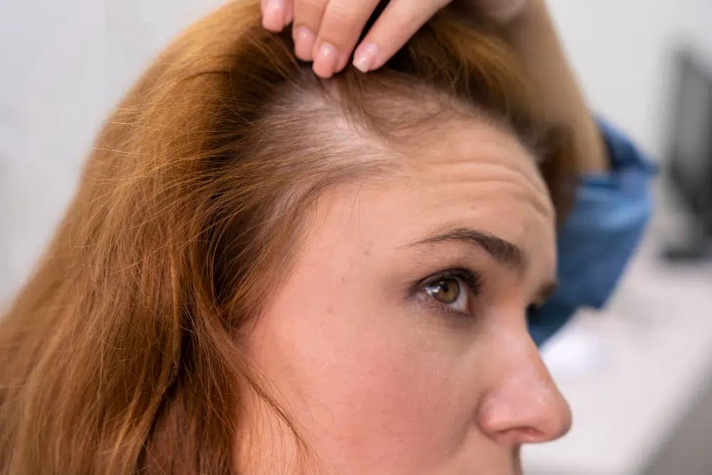 Female DHI Hair Transplant