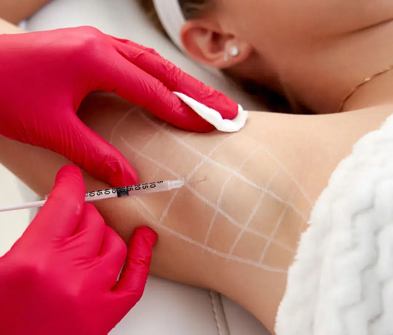 Perspiration Reduction (anti-sweat) (Hyperhidrosis Treatment)
