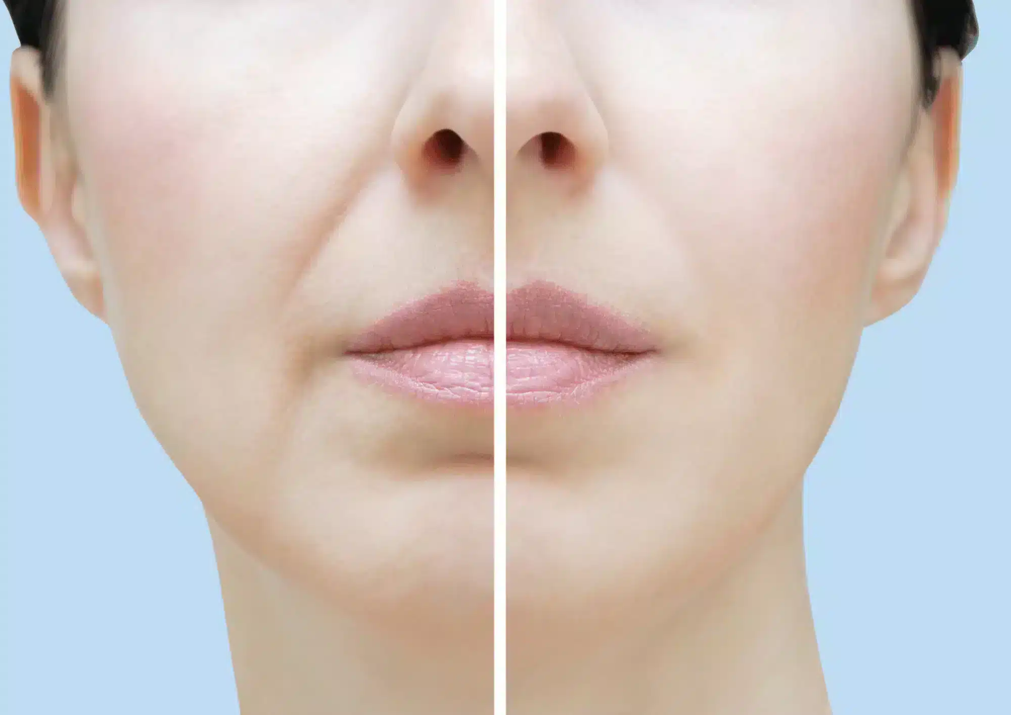 Fillers for Midface, Chin, Nasolabial Folds – Juvederm (1ml)