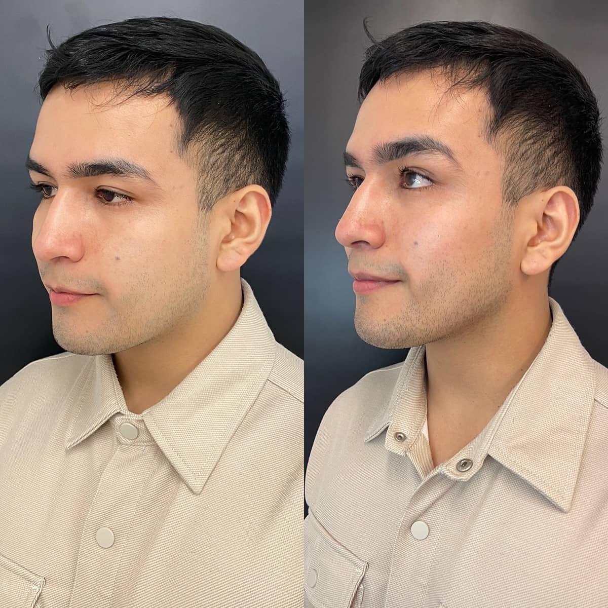 Jawline Sculpting – Juvederm (5ml)